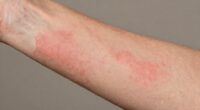 signs of skin barrier damage